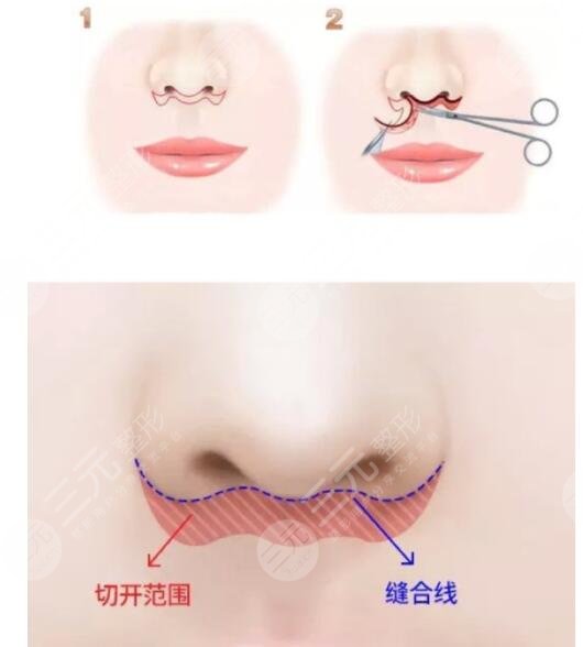 北京张曼医生人中缩短技术好吗?