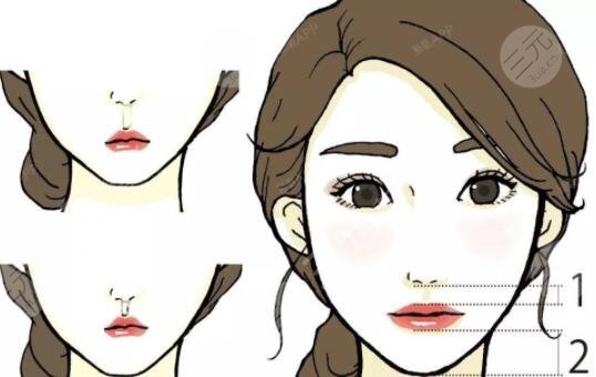 北京张曼医生人中缩短手术之后有哪些注意事项呢?