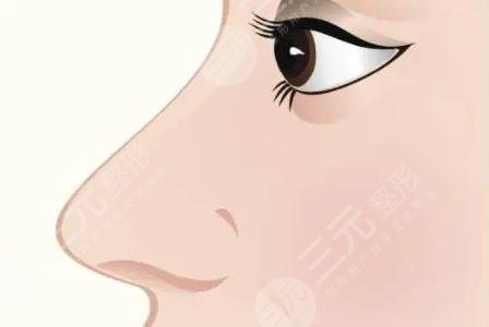 隆鼻手术