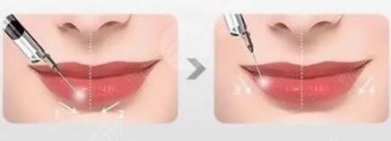 张曼医生做唇排名第几？医生特点介绍，唇部整形案例来袭！