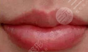 张曼医生做唇排名第几？医生特点介绍，唇部整形案例来袭！