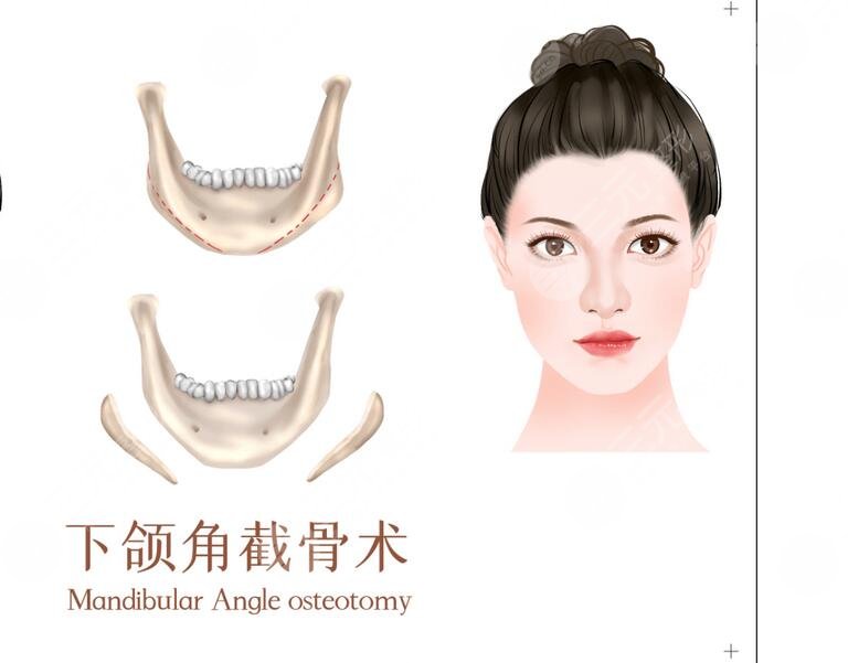华山医院做下颌角手术好吗?