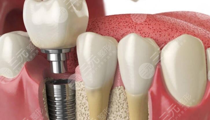 上海做半口牙齿种植应该怎样选择医院?