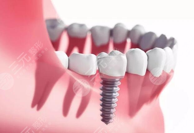 半口牙齿种植术后怎样护理?