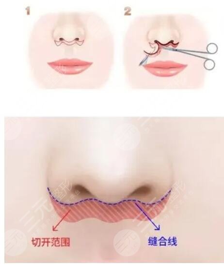 北京张曼美容医生怎么样？个人资料，擅长唇部整形与人中缩短手术