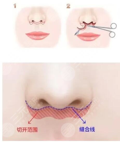 北京张曼美容医生怎么样？个人资料，擅长唇部整形与人中缩短手术