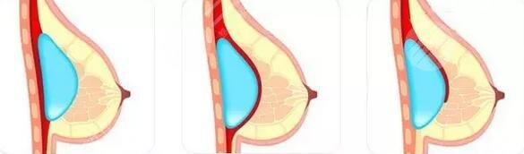 欧阳天祥医生隆胸案例