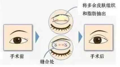 眼部吸脂手术的价格贵吗？精细塑形不简单，美眼花费参考！