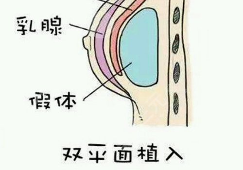 双平面假体隆胸弊端优缺点
