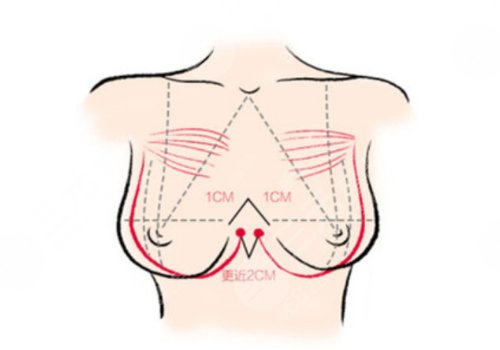 双平面假体隆胸弊端优缺点