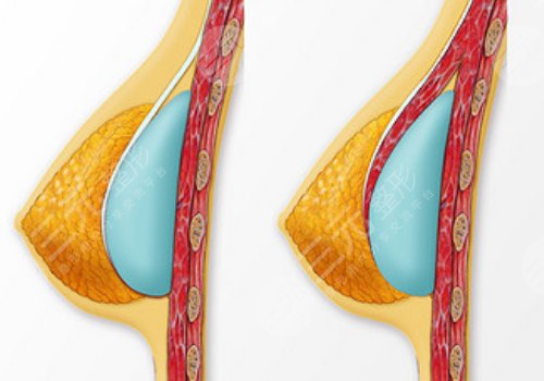 双平面假体隆胸弊端优缺点