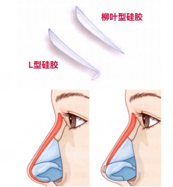 上海同济医院整形外科隆鼻案例分享