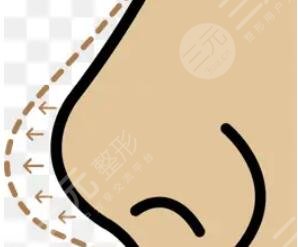 隆鼻