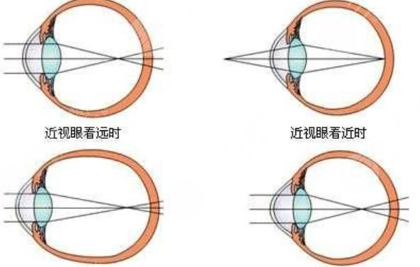近视眼