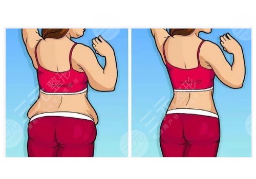 水动力吸脂多少钱一部位