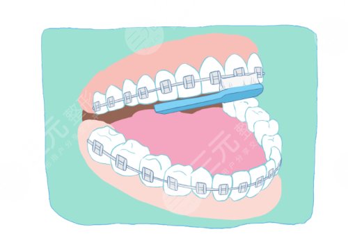 西安天皓口腔医院牙齿矫正价格是多少