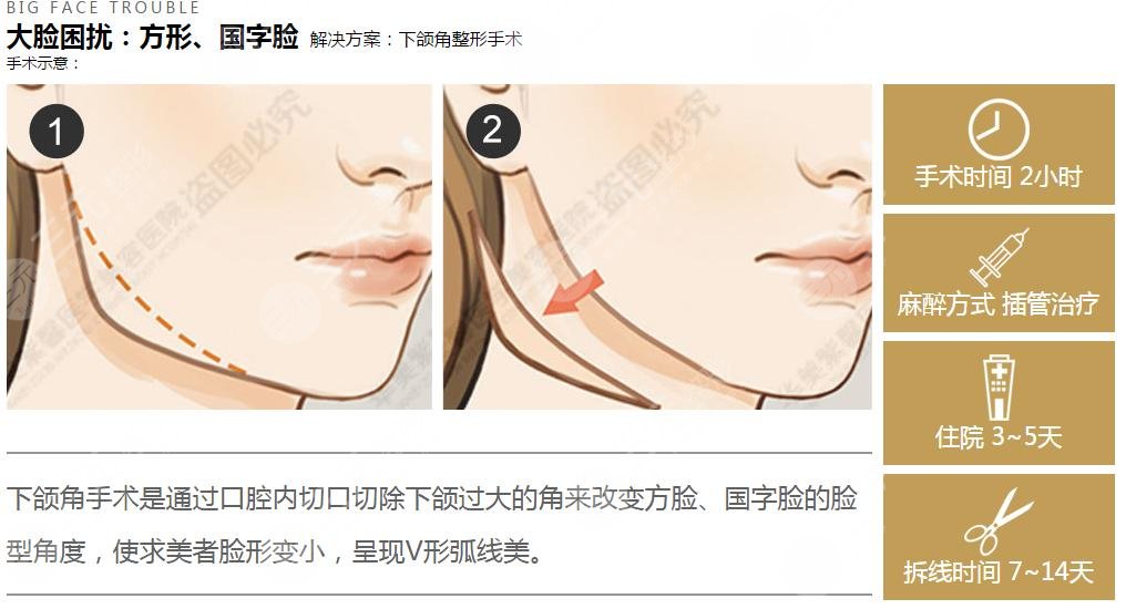 北京黄大勇下颌角磨骨整形相关案例