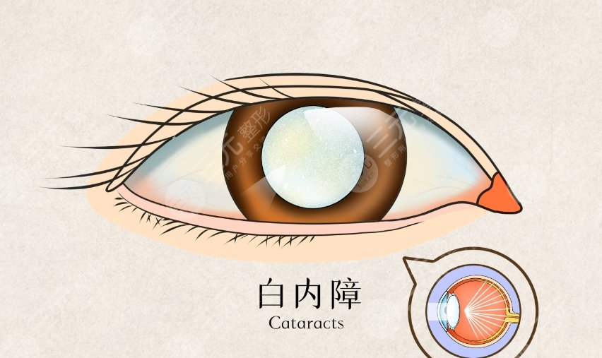 白内障