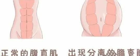 腹壁整形手术之后会留疤吗?