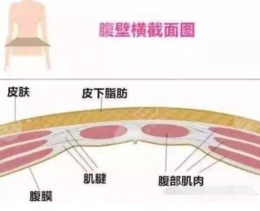 腹壁整形手术之后需要注意些什么?