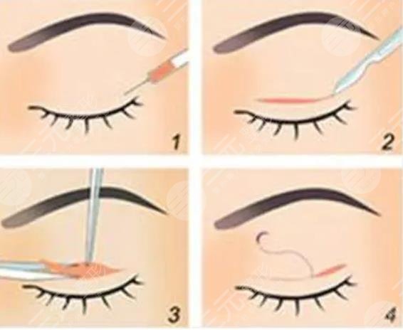 上海华山医院丁志医生双眼皮案例