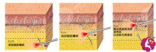 齐永乐医生吸脂瘦大腿案例