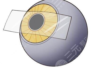 人工晶状体植入