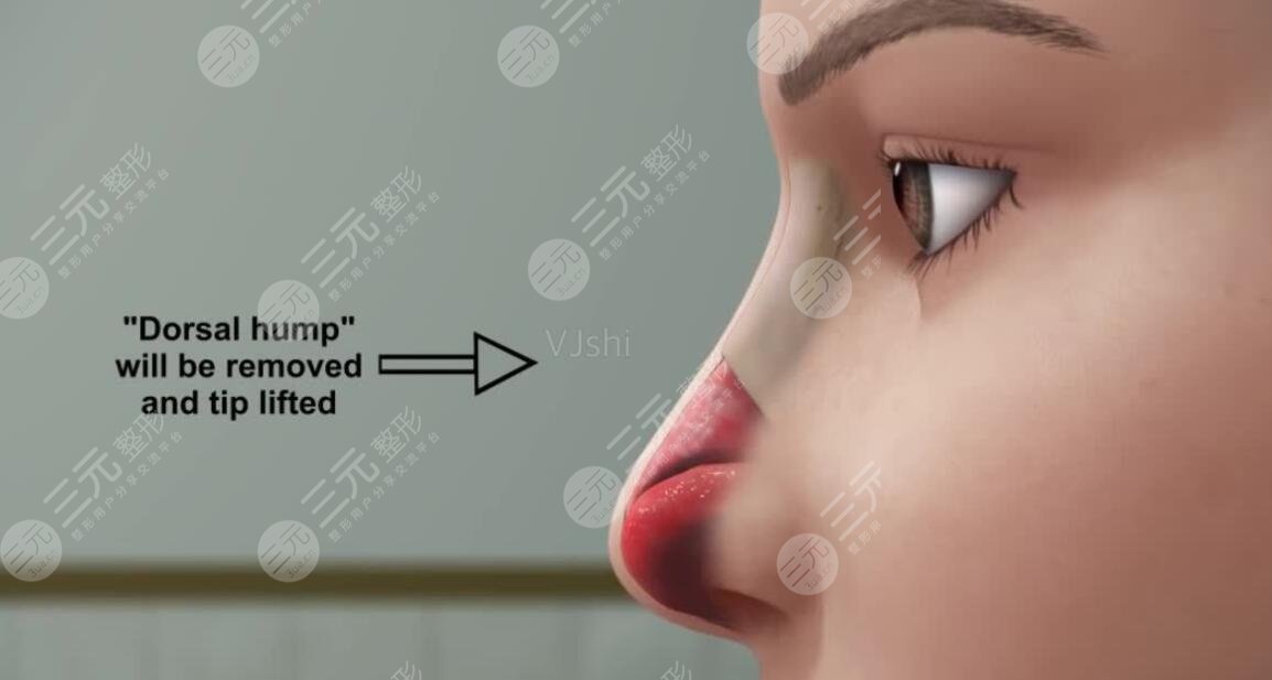 鼻综合