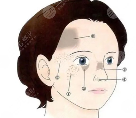 脖子胎记