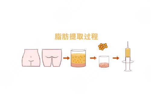 填充面部整形要多少钱