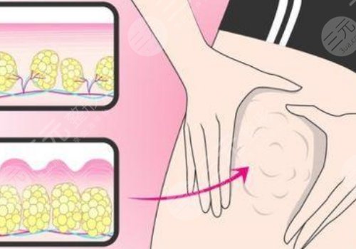 郑州华领整形抽脂怎么样