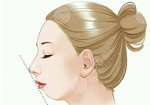 下颌角整形手术多少钱