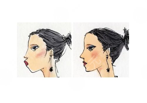 面部填充一般多少钱