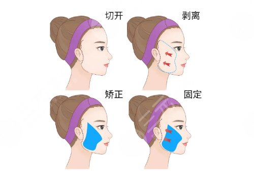 拉皮手术能维持几年