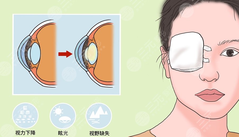 白内障