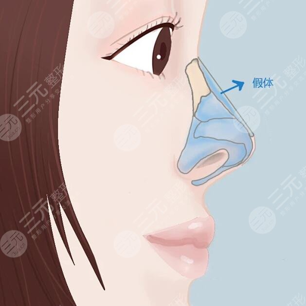 胡斌医生做鼻子的技术特点