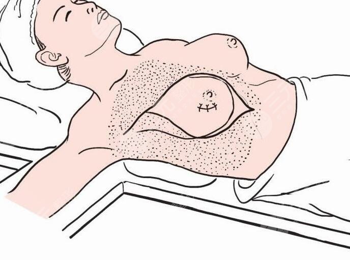 双平面隆胸优点