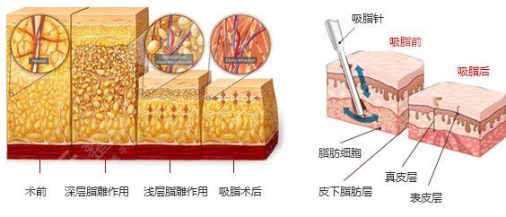 上海国际医学中心整形科麻荪香医生抽脂案例参考