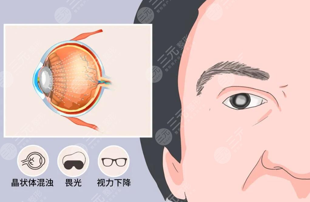 白内障