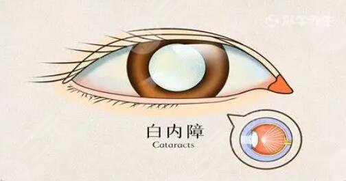 白内障