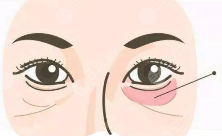 去眼袋是动手术好还是微创好？2种方案，优缺点及价格对比，教你挑选！