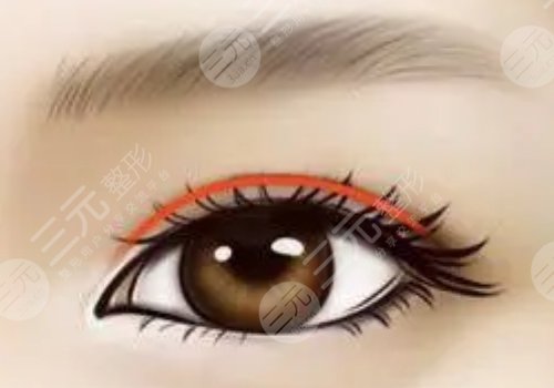 中关村敖健飞做双眼皮怎么样