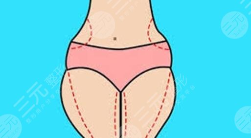 大腿吸脂