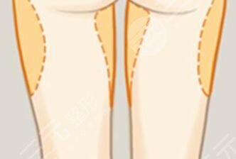 大腿吸脂