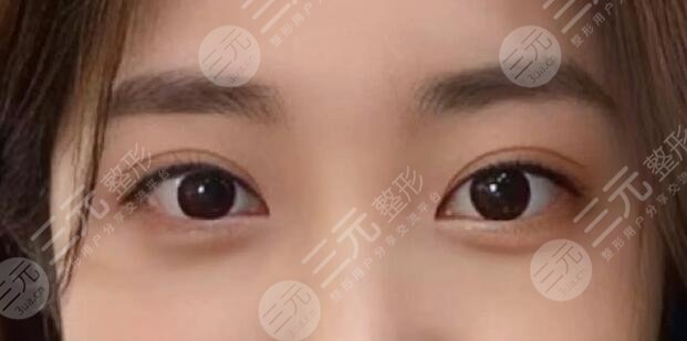 肖贵喜医生做双眼皮怎么样啊?医生个人实力测评,就职医院是哪家?