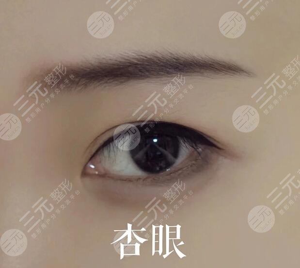 张守玲医生双眼皮手术案例