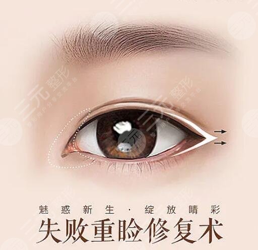 刘风卓医双眼皮手术修复手术案例