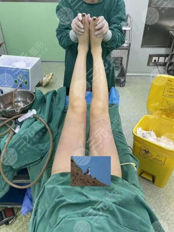 王俊河医生吸脂手术案例