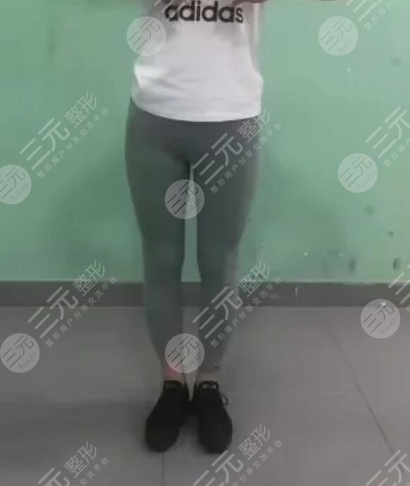 王俊河医生吸脂手术案例