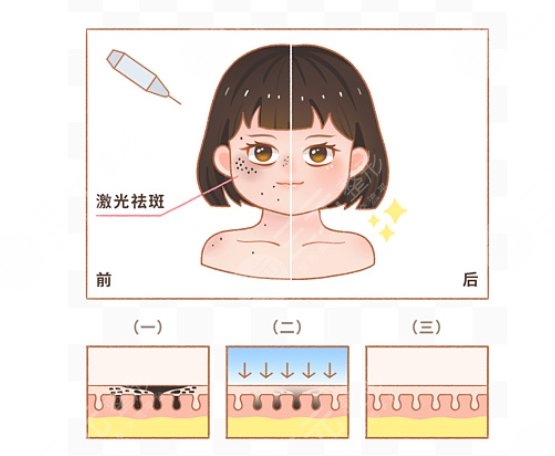 激光祛斑